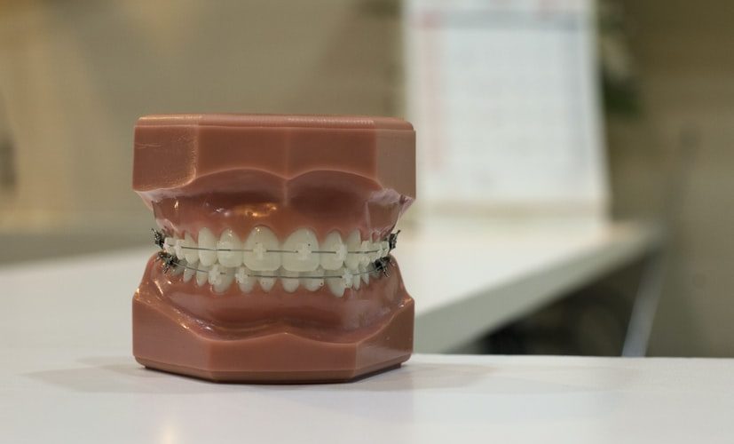 dental prosthesis model with brackets