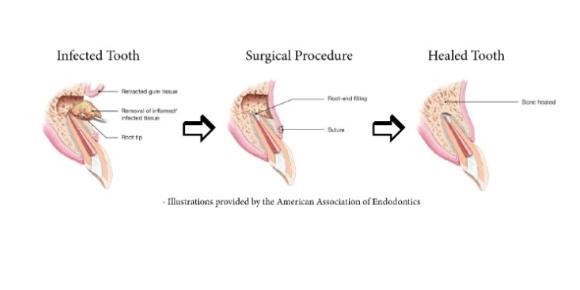 Illustration of the apioectomy procedure