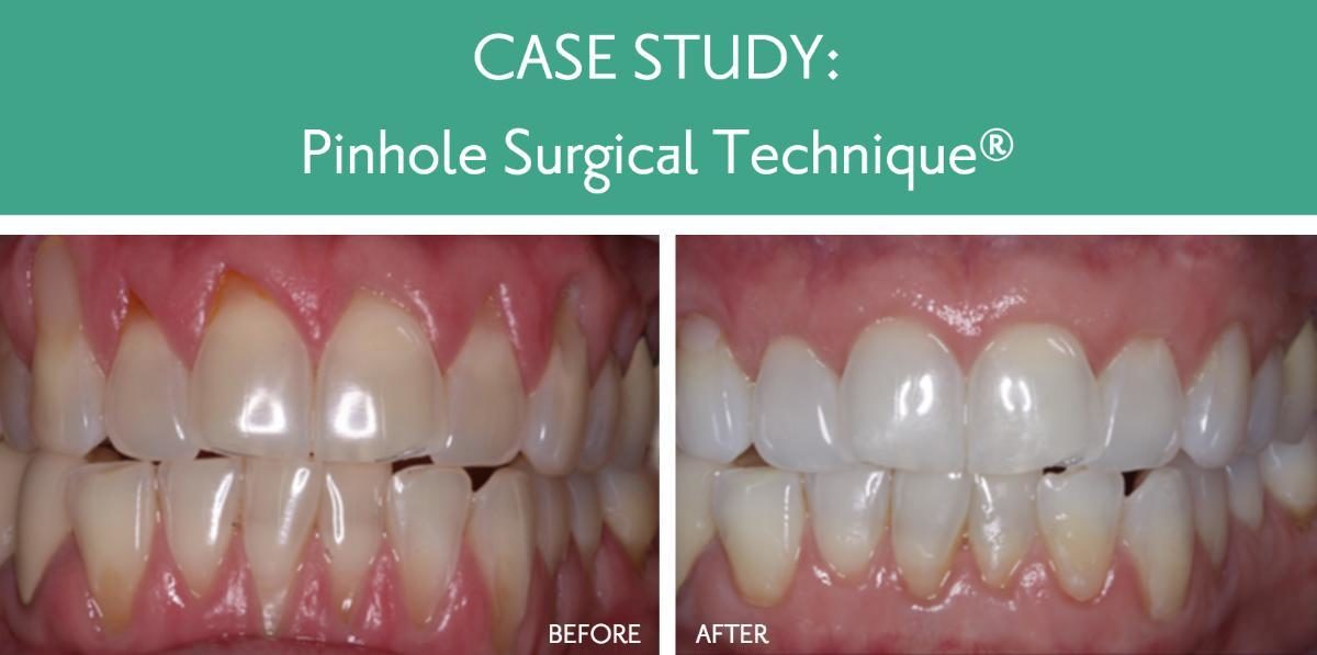 Example of teeth before and after Chao Pinhole Surgical Technique