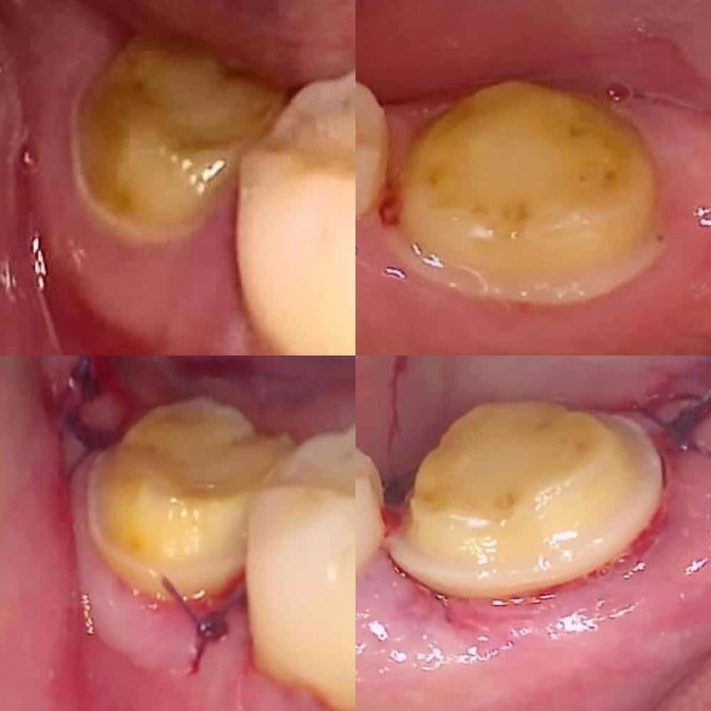 crown-lengthening-procedure-cascadia-dental-specialists