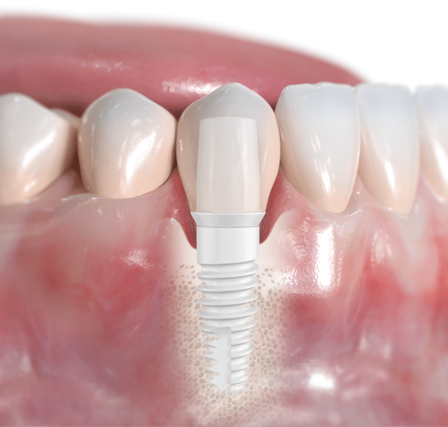 NobelPearl ceramic implant, a metal free alternative to titanium implants