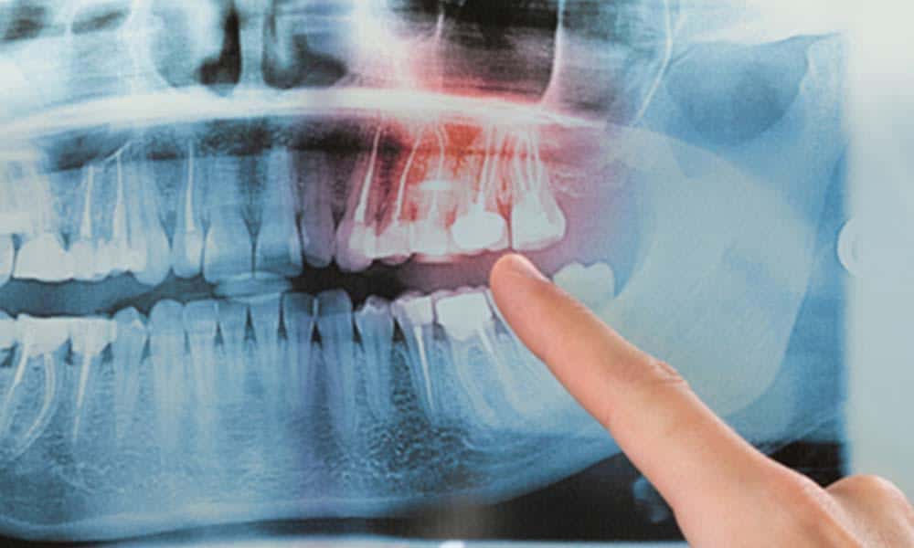close up of x-ray of teeth with problems