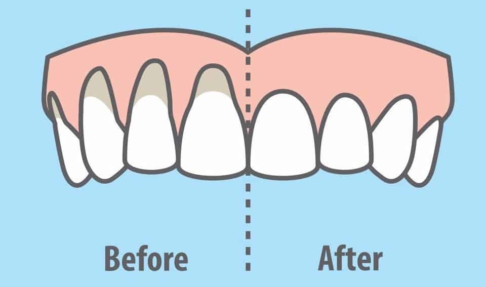 CT Scans for Root Canal Issues Cascadia Dental Specialists