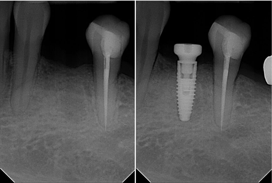 before and after titanium endosteal implants